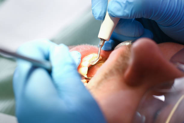 Best Emergency Tooth Extraction in Rhinelander, WI